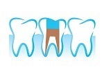 Root Canal in Richmond Hill